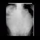 Meteorism, distention of colon, reflex distention, vertebrogenic pain syndrome, compression fracture of vertebra: X-ray - Plain radiograph